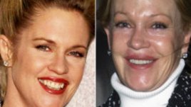 Най-несполучливите пластични операции на известни личности