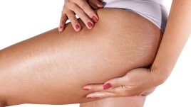 Домашен лосион против стрии с кокосово масло