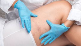 Домашни трикове срещу разширени вени