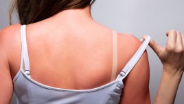 Ако сте изгорели, направете тези 10 неща