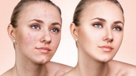 Домашен мехлем за акне с етерични масла