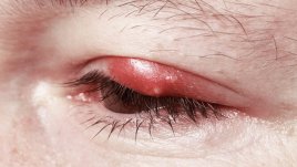 Домашни лекове при ечемик на окото