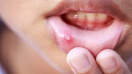 Причини, симптоми и лечение на язви и афти в устата