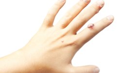 Естествени лекове при брадавици