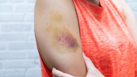 Причини за лесна поява на синини по тялото