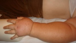 Лимфедемът вече е лечимо състояние