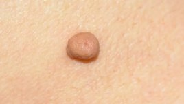 Лесен начин за премахване на папиломи