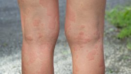 Природни лекове при уртикария 