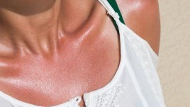 Какво да не правим при слънчево изгаряне