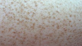 Как да преглеждаме кожата за съмнителни пигментни петна?