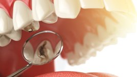 Трикове за предпазване от кариес