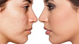 Храни, потискащи симптомите на акне (галерия)