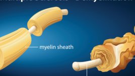 Неочаквани предпоставки за развитие на множествена склероза
