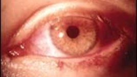 Кой страда по-често от „сухо око”