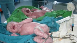 Родиха се първите близнаци от инвитро бременност в „Майчин дом“