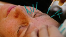 Странични ефекти от акупунктурата