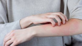 Натурални начини за облекчение на екзема 