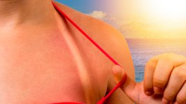 Вълшебни природни методи против изгаряния 