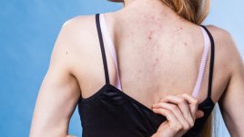 Ефективни природни методи срещу акне по гърба  