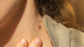 Натурални начини за премахване на папиломи по кожата