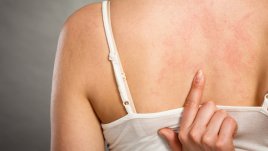 Коварни симптоми на лупус, за които не подозирате 