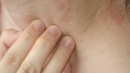 Що е то студова алергия?