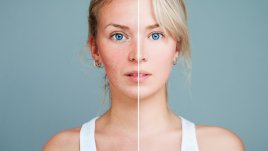 Във ВМА се провеждат безплатни консултации за акне