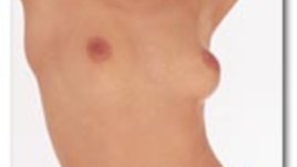 Корекция на бюста