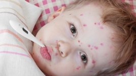 Варицелата, малките деца и възрастните