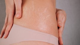 6 продукта, които ще ви спасят от стриите