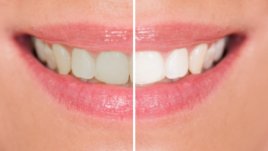 Неочаквани причини зъбите ви да се оцветят