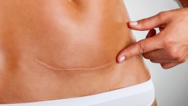 Как да заличим неприятните белези