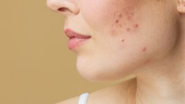 Диета при проблемна кожа