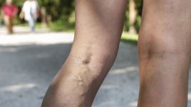 Домашни лекове срещу спукани капиляри