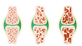 На всеки час в България се регистрират по шест фрактури заради остеопороза