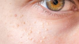 Натурални средства срещу бели точки по кожата 