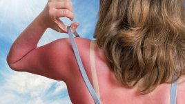 Как се променя тялото ни само след едно изгаряне? 