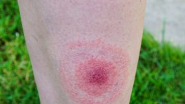 Безплатни прегледи във ВМА за лаймска болест и инфекции при ухапване от кърлеж