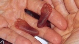 В САЩ се роди най-недоносеното бебе