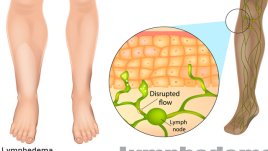 Безплатни прегледи за лимфедеми във ВМА