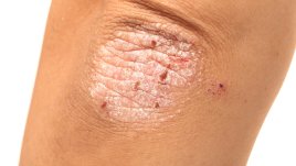 5 от най-добрите храни при псориазис 