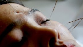 При кои болести ни помага акупунктурата?