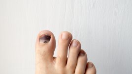 Възможни причини за почерняване на ноктите 