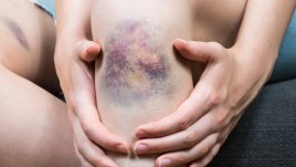 8 причини за необясними синини по тялото 