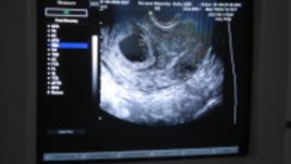 Пренатална диагностика