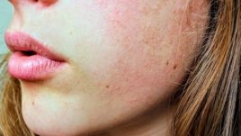 Безплатни прегледи във ВМА за акне