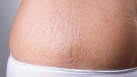 Натурални грижи при стрии