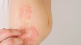 Кожен симптом, който може да подсказва за непоносимост към глутен