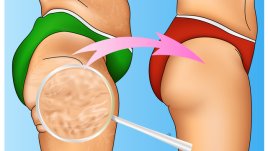 4 храни срещу целулит