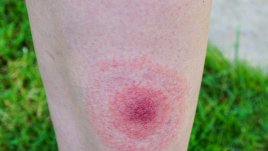 Безплатни прегледи във ВМА за лаймска болест